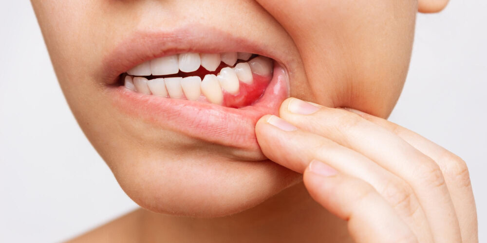 diabetic mouth ulcers and sores