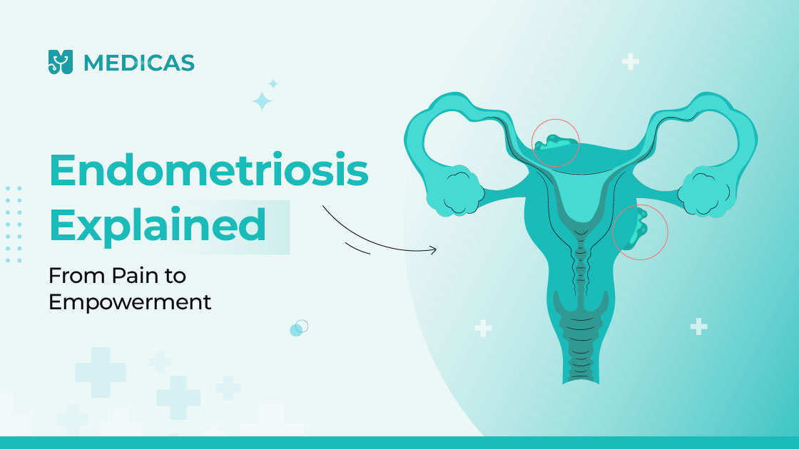 endometriosis