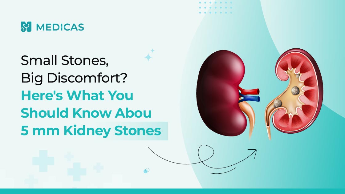 5mm kidney stone