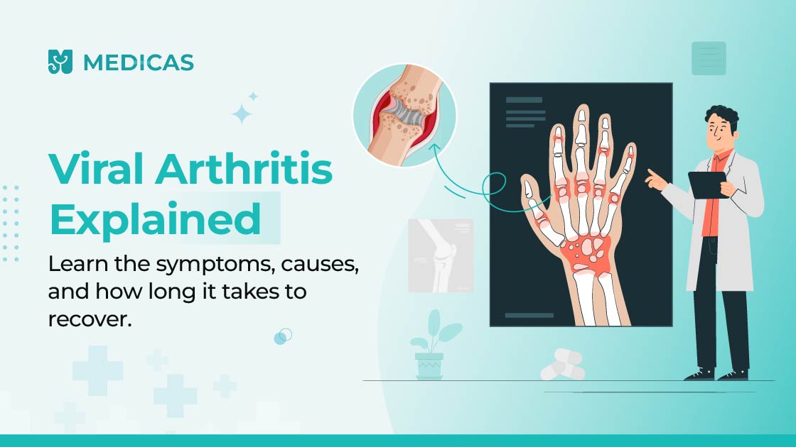 viral arthritis